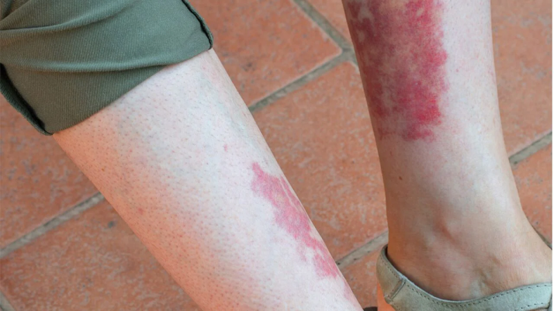 واسکولیت؛ علایم و نشانه ها