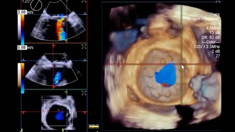 اکوکاردیوگرافی پیشرفته