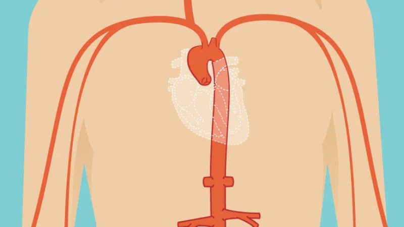 درمان بیماری های آئورت