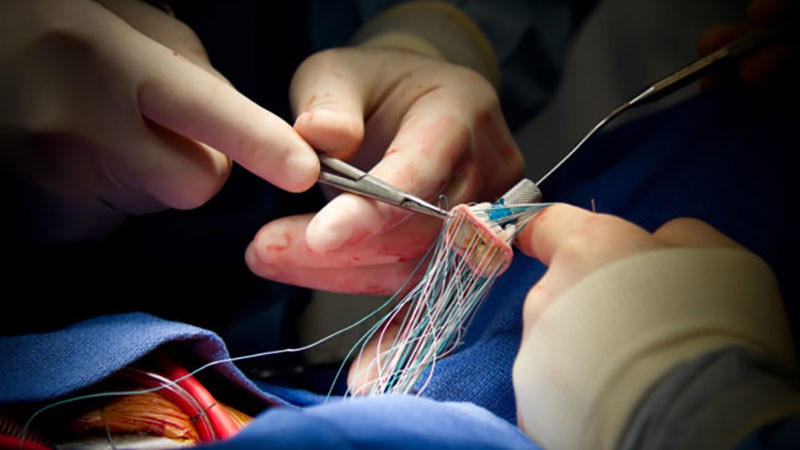 تعویض دریچه